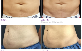 truSculpt® 3D before and after