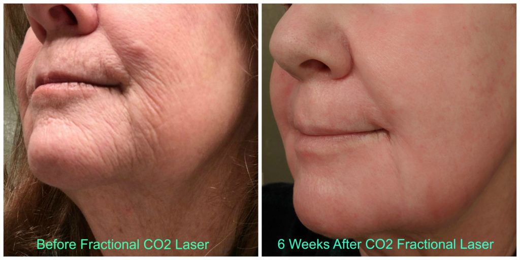CO2 Fractional Laser Before & After | Glow Aesthetic Medicine