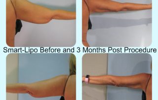 Cynosure SmartLipo Before and After results on arms