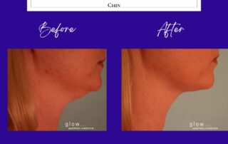 before and after chin liposuction