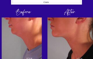 before and after chin liposuction