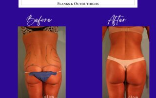 flank liposuction before and after
