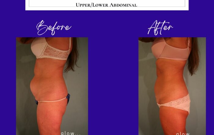 Before And After Testimonials Glow Aesthetic Medicine • Colorado Springs 4568